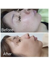 レン(Ren)/ハーブピーリング(剥離なし3回)