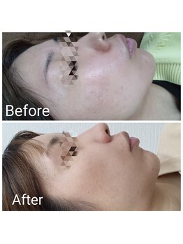 レン(Ren)/ハーブピーリング(剥離なし3回)