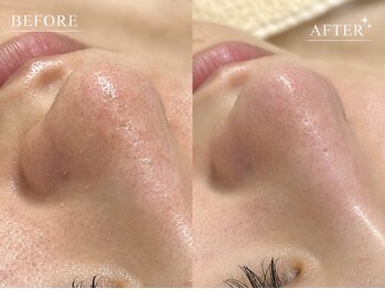 エルビウ(ELBIU)の写真/《ララピール×毛穴洗浄で肌質ケア☆》黒ずみ、毛穴開き、メイクで隠し切れない、お悩みに相談可能◎