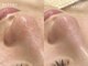 エルビウ(ELBIU)の写真/《ララピール×毛穴洗浄で肌質ケア☆》黒ずみ、毛穴開き、メイクで隠し切れない、お悩みに相談可能◎