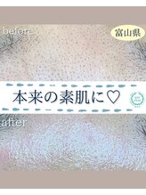 サロン リュンヌ(salon lune)/毛穴エクストラクション