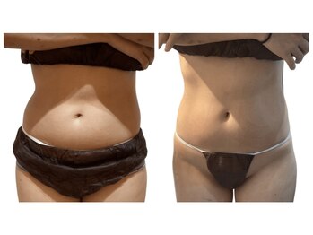 痩せラボ/お腹サイズダウン【痩身】