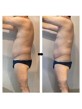 伊達男/フォースカッター事例