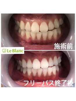 ルブラン 奈良店(Le Blanc)/20回で確実に白く！！