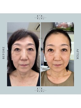 モア(eyelash salon MOOR)/最強フェイシャル