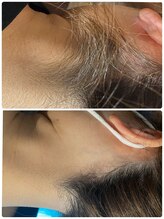 エルール トータルビューティ(Aileure total beauty)/うなじ脱毛