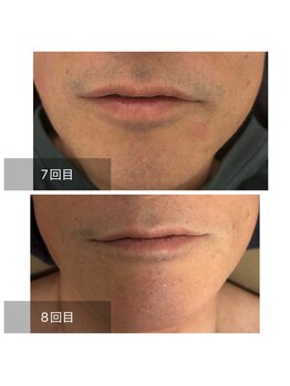 ダンニヒル(dannihil)/【髭脱毛】40代会社員8回目