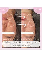 ミュー 豊田店(mieux)/◆揺らぎ肌の駆け込み寺