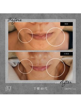 ゴーマルイチ(501)/光フェイシャル Before/After