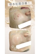 ビューティーサロン シンデレラ 心斎橋本店(Cinderella)/根本肌質改善もお任せください☆