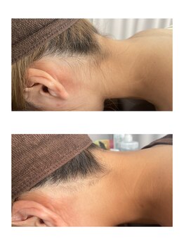 ミース 北九州店/脱毛1回目から驚くほどスッキリ!