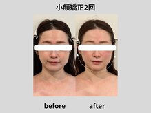 ビトリア 横浜店(BITORIA)/本格小顔矯正