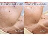 【写真に自信！小顔ケア】筋膜リリースでたるみケア 13,200円→11,200円 60分
