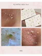 ミルフィオリ(Mille fiori)/毛穴詰まり