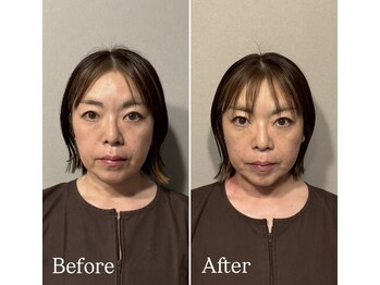 鍼灸院エミュ(Emu)/美容鍼でスッキリ