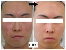 ニコ(nico)/ニキビ、乾燥、赤味
