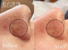 アトリア(ATRIA)/オススメ☆毛穴洗浄コース