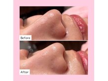 ホワイトラボ 天王寺(White labo)の雰囲気(毛穴洗浄しながら美容成分を補給するハイドロフェイシャル☆)