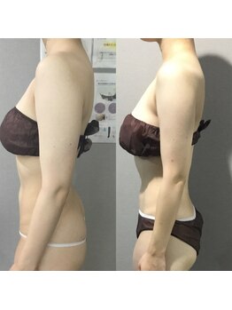 ヴィノ アイサロン(VINNO eyesalon)/最強バストアップコース