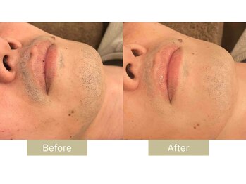 リフサロ(Rifsaro)/ヒゲ脱毛5回 Before/After