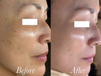 ローズルート(Rose route)/40代前半ママさん　10回施術