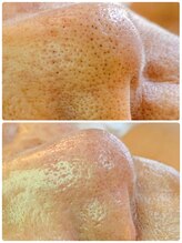 シェルビー(Cielbe.)/毛穴エクトラクション