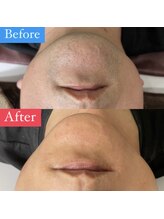 ウルル(ULuLu)/ヒゲ脱毛12回目のお客様