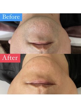 ウルル(ULuLu)/ヒゲ脱毛12回目のお客様