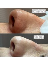 ライカブルー(RaicA BluE)/施術写真　before-after