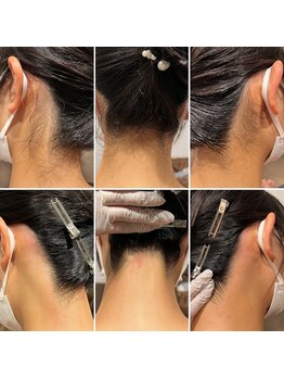 メローワックス 松本駅前店(MELLOW WAX)/うなじWAX脱毛ビフォーアフター