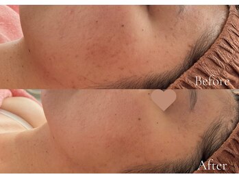 綺麗サロン 脱毛アンドフェイシャル ジュエル(Jewel)/【4BミネラルクリアTR】