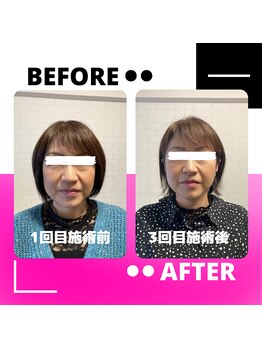 はりん美鍼灸/小顔矯正モニター 第一弾 2