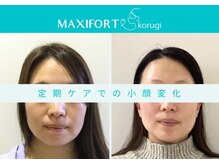 マキシフォート 名駅店(Maxifort)/定期ケアでの小顔変化
