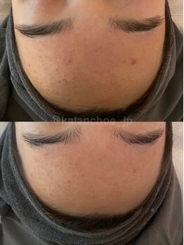 カランコエ(KALANCHOE)/おでこのお悩みにも