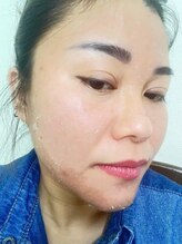 エミリー(Emily)/ハーブピーリング