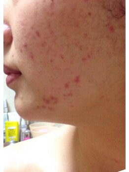 スキンケアスタジオ アコ 新宿店(Aco)/GP肌活２Dのお客様