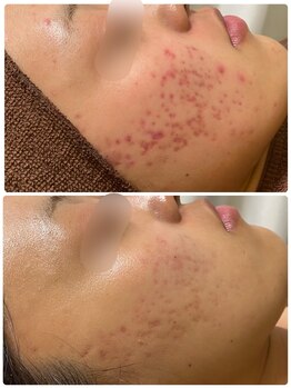 ビオプラス(BioPlus+)/川崎/ハーブピーリング