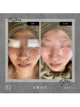 ゴーマルイチ(501)/光フェイシャル　Before/After
