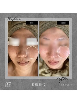 ゴーマルイチ(501)/光フェイシャル Before/After