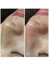 ユニ(uni.)/毛穴エクストラクション