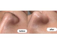 毛穴洗浄＋ポレーションbefore⇒after！納得の毛穴レス肌に