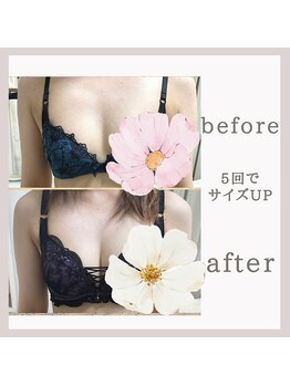 アリサナ(Arisana)/症例写真　バスト　葛西