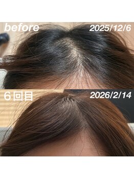 経堂鍼灸整体院/育毛促進鍼+ヒト幹細胞培養液