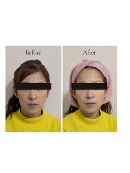 ミヤビ(miyabi)/ルネセルスキンケア体験