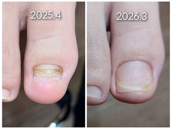 【欠損爪】最短で回復した例