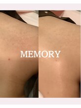 メモリー(MEMORY)/お背中のニキビも改善♪