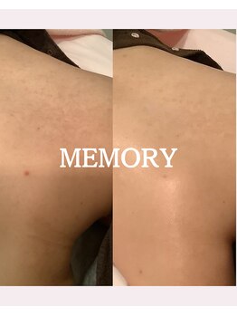 メモリー(MEMORY)/お背中のニキビも改善♪