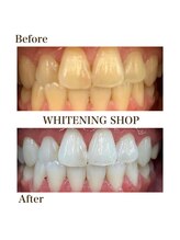 ホワイトニングショップ 豊橋店(WHITENING SHOP)/Before&Afterホワイトニング豊橋