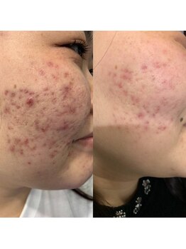 ラヴィオス 渋谷表参道店(RAVIOS)/肌質改善 ハーブピーリング 全顔