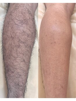 グルーミー(gloomy)/ジメジメ！梅雨時はワックス脱毛